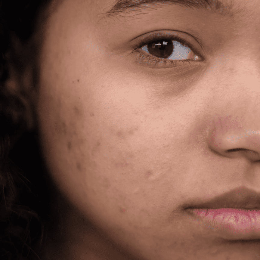 How does contraception affect my skin?